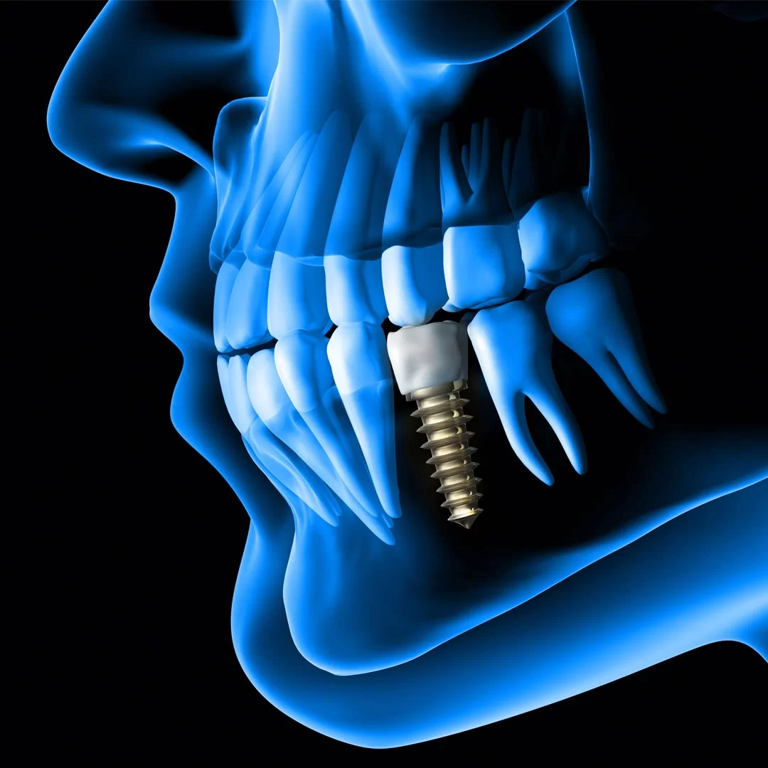 How to Choose the Best Dental Implant clinic in Dubai